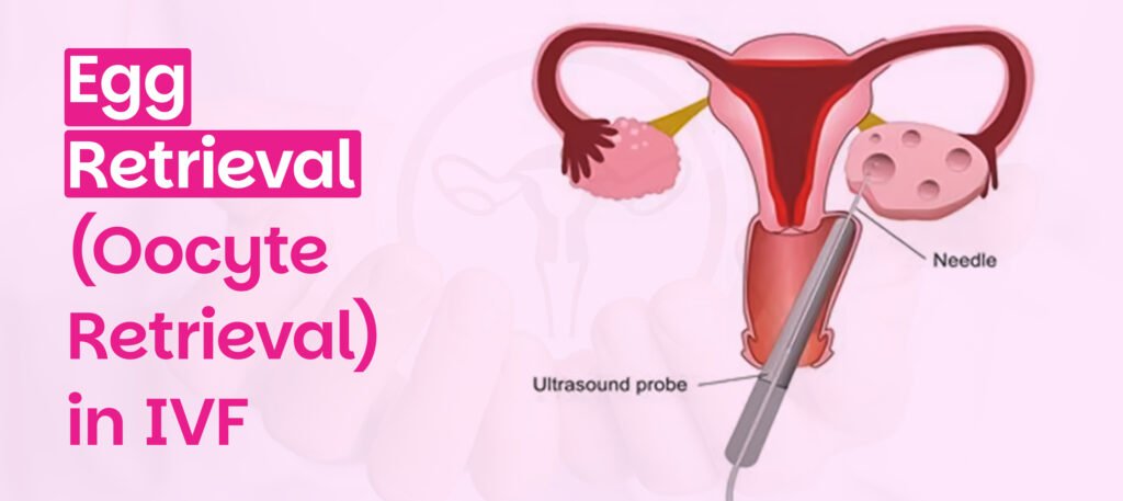 Medical illustration of egg retrieval (oocyte retrieval) in IVF showing ultrasound-guided needle extraction from ovaries, used by Vrinda Fertility to explain the IVF process.